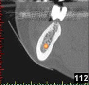 3D-Implantatplanung - Detailaufnahme 2